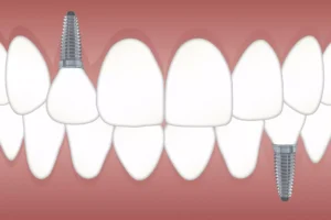 cấy ghép implant