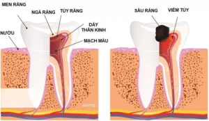 Viêm tủy răng